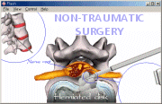 non traumatic spine surgery animation